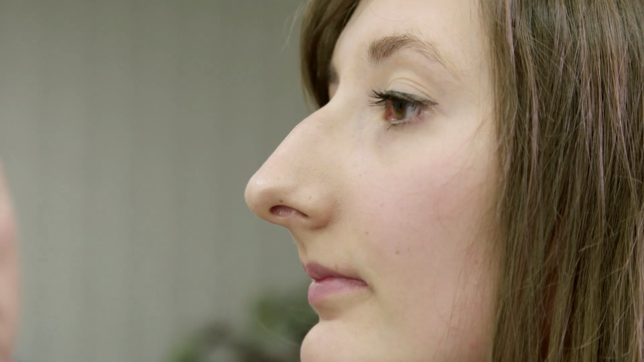 Alice – Rhinoplastika. Zmenšení a modelace nosu | Stream